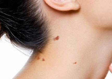 Skin Tag