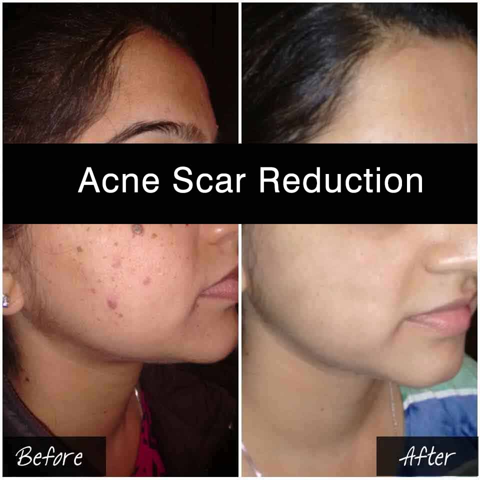 does clindamycin remove acne scars