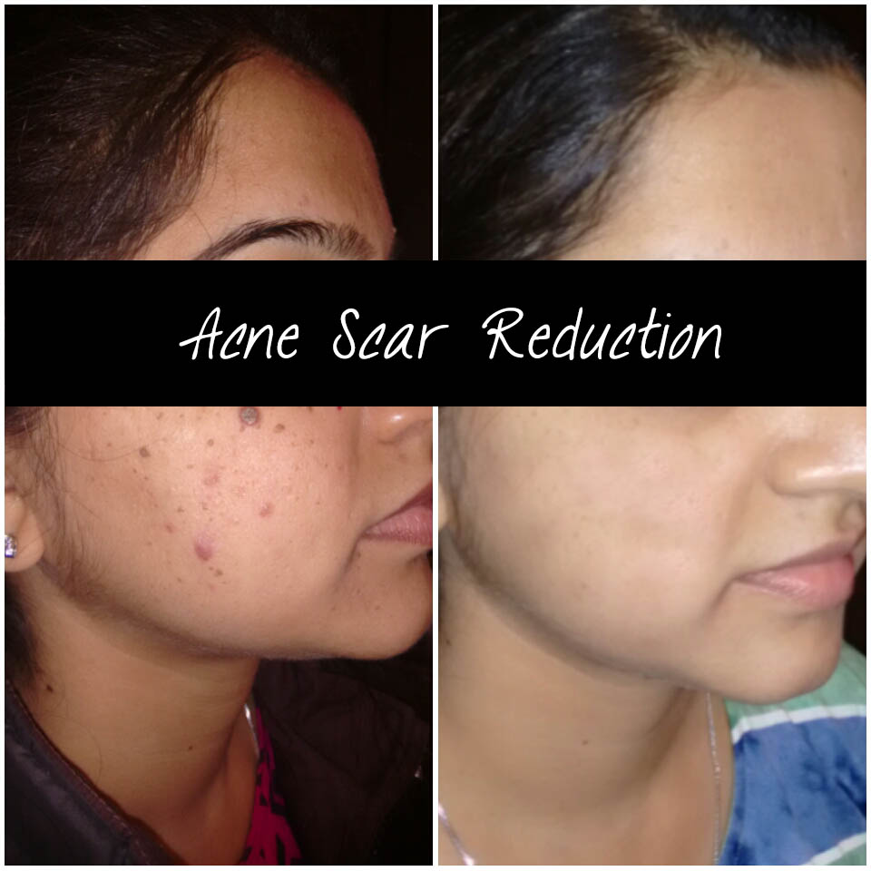 acne treatment in jaipur