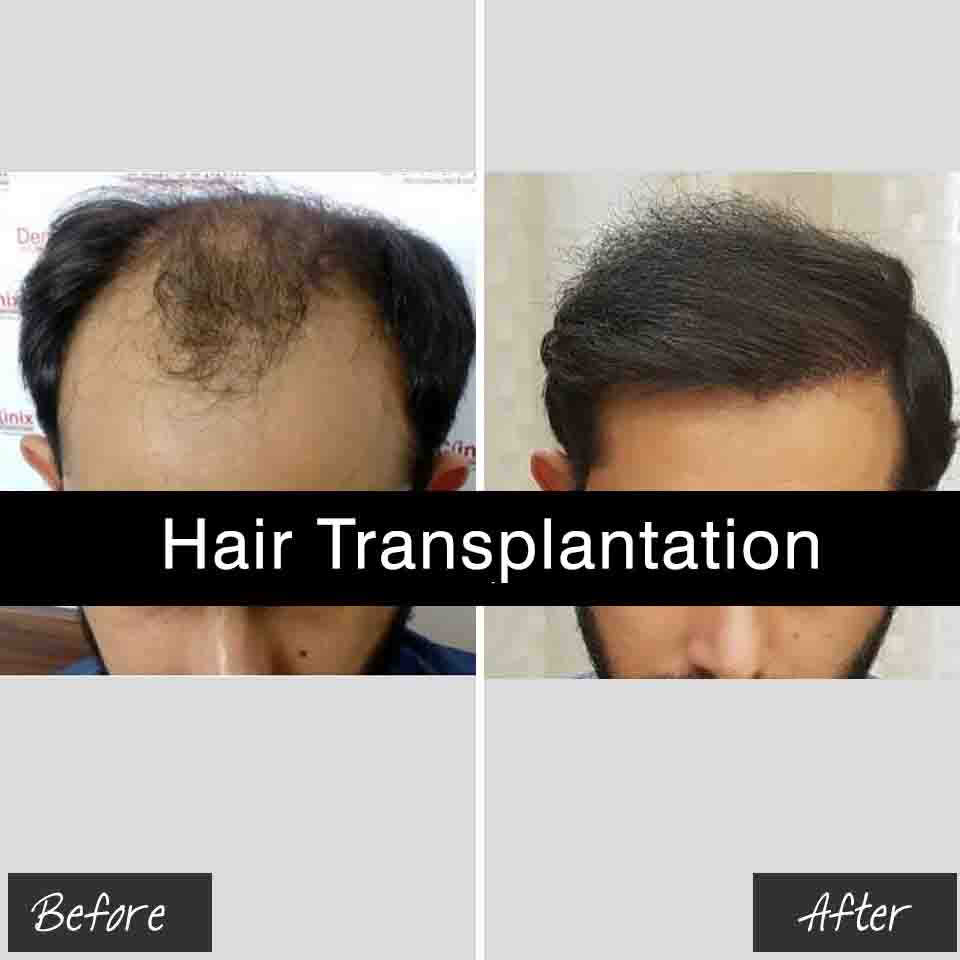 Best Hair Transplant Treatment In Jaipur By Dr Vishal Chugh
