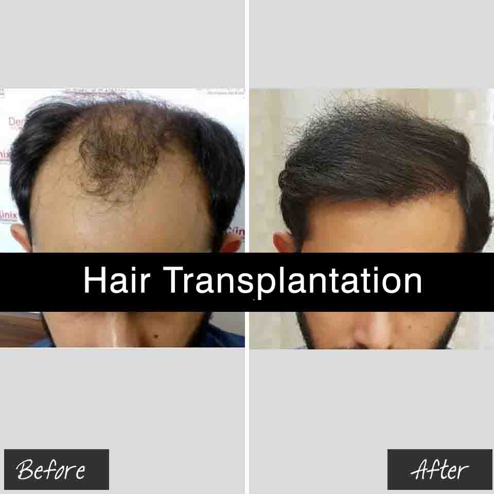 best hair transplant treatment in jaipur