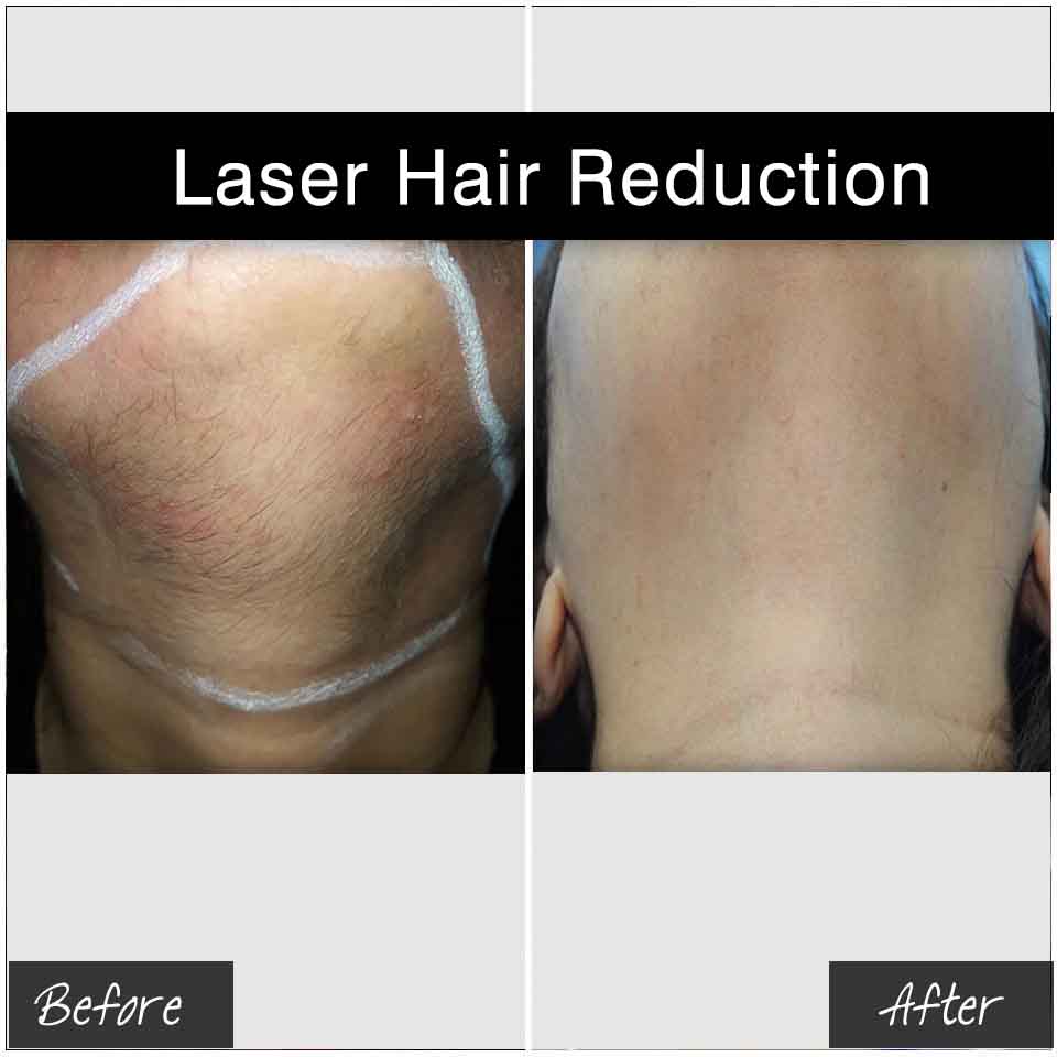 Hair removal FAQ'sI  Chugh, Laser hair removal,radiant skin clinic