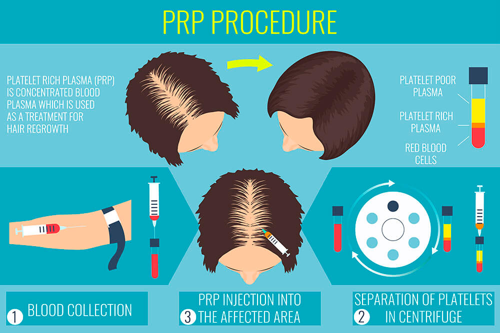 PRP hair treatment Practo