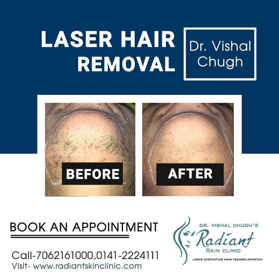 Laser Hair Removal - Radiant Skin Clinic- Laser Hair Removal &  Dermatologist in Jaipur