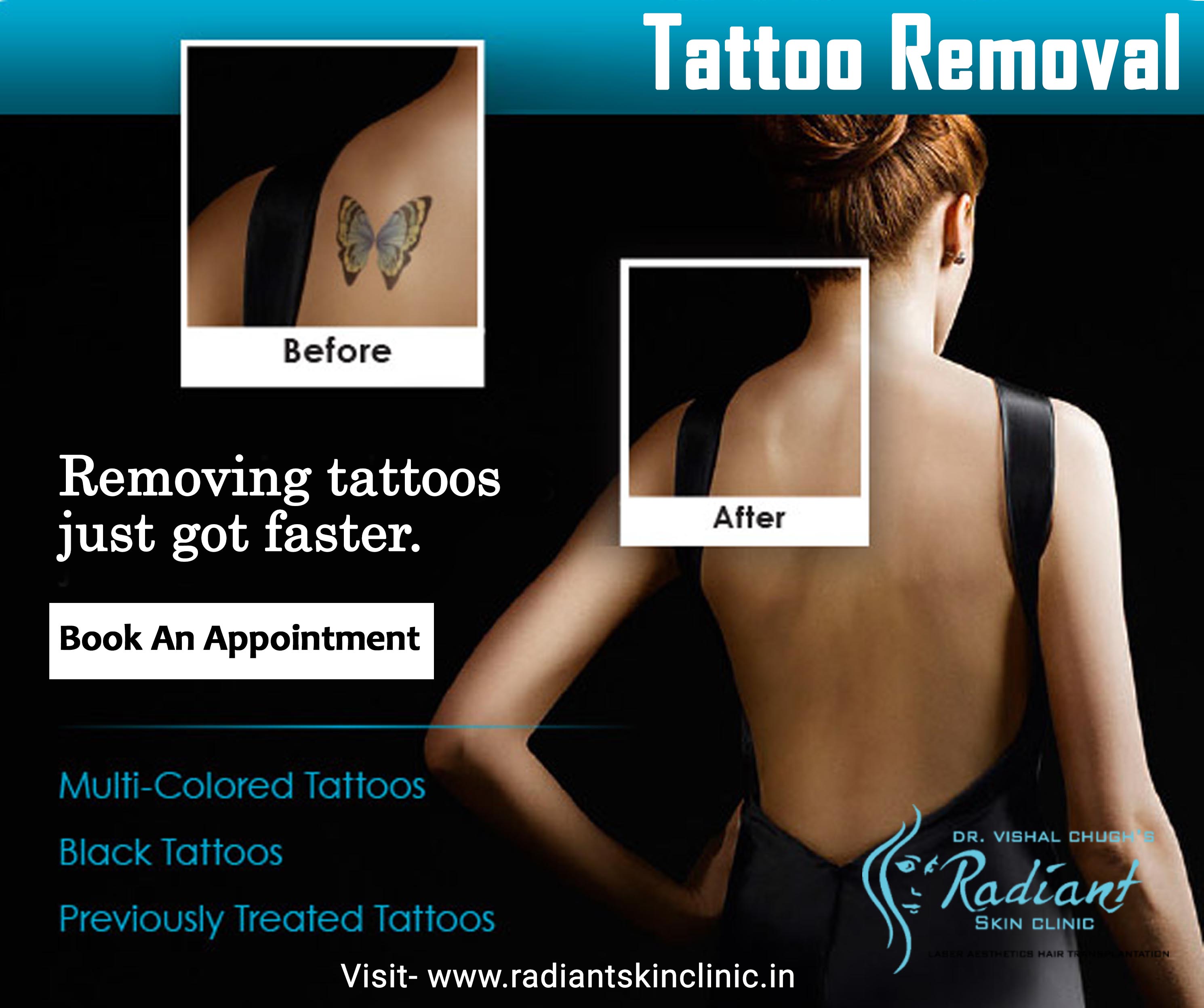 tattoo removal in jaipur