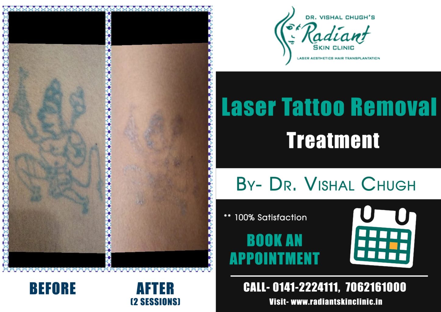 Tattoo Removal Patch Test | IPL Treatments | Laser Skin Therapy