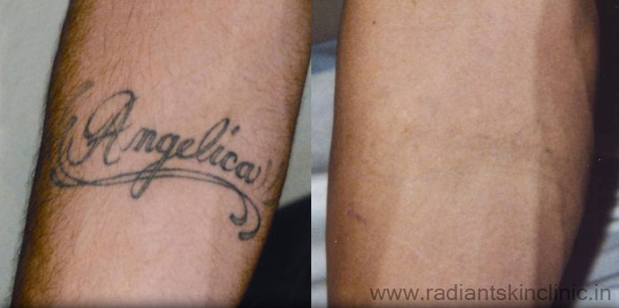Before  After Images of Laser Tattoo Removal treatment  Orchid Cosmo laser