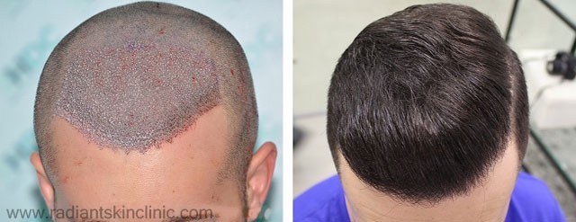 hair transplant