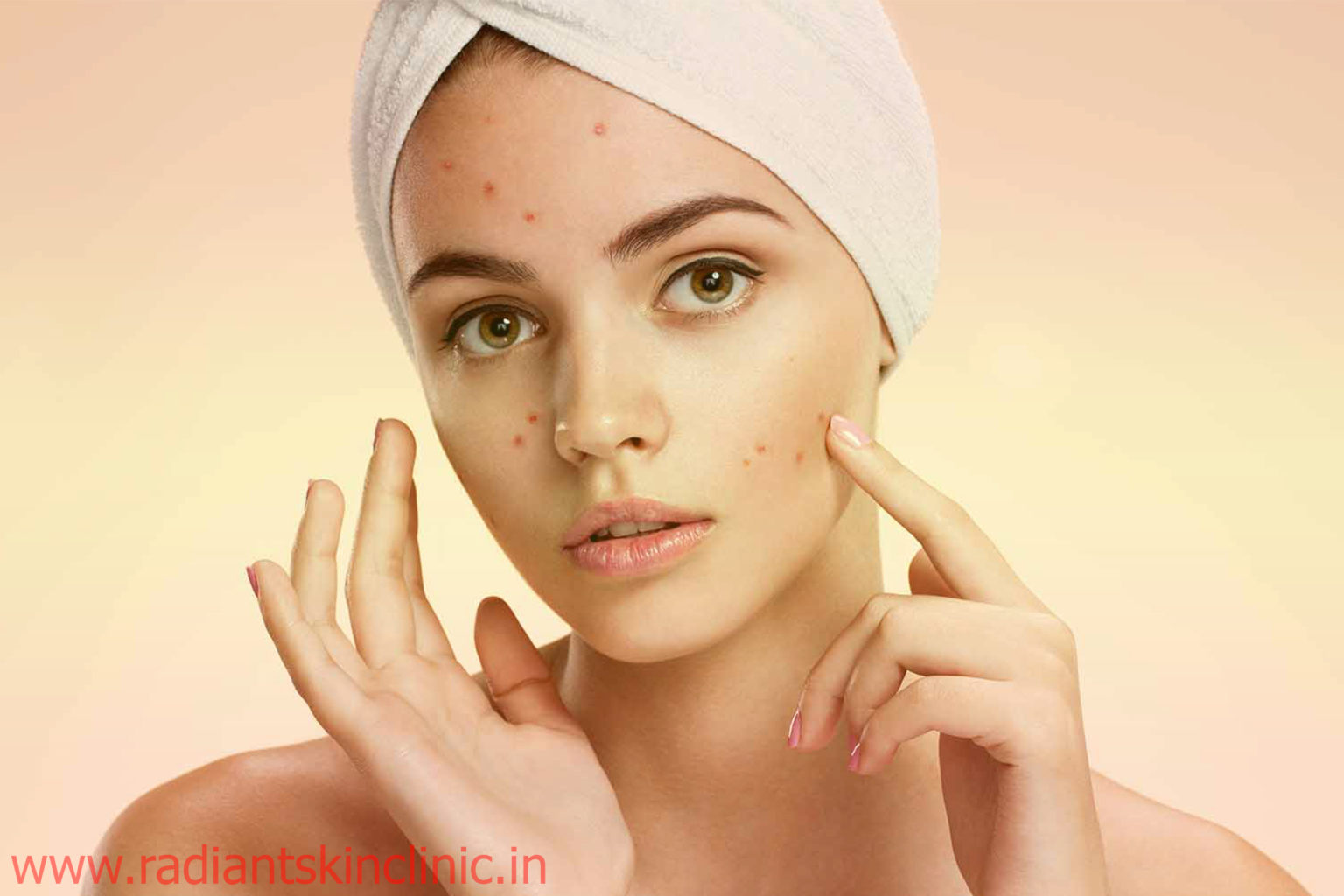 Acne Treatment in Jaipur