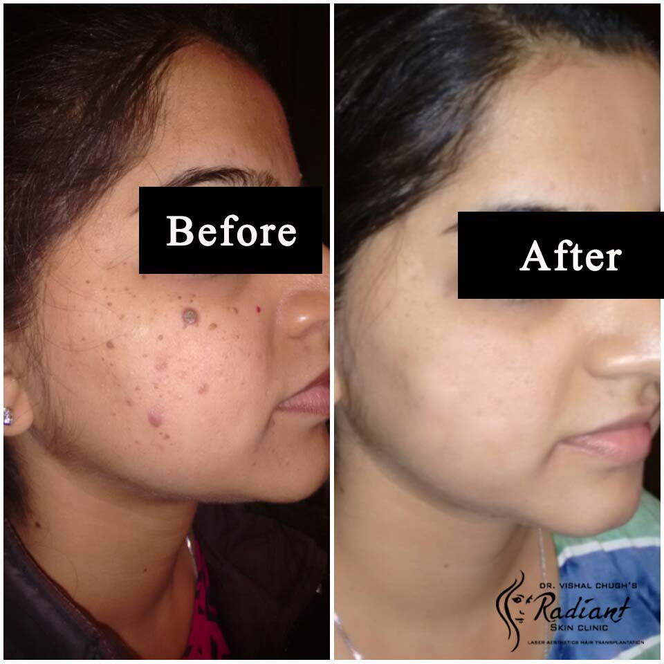 Best Acne Scare Removal Treatment in Jaipur Radiant Skin Clinic