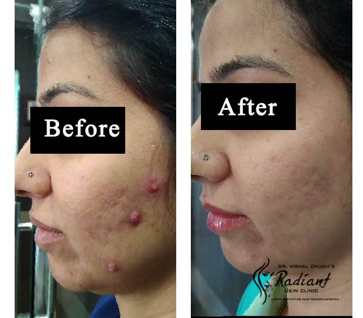 Laser Treatment for acne scar removal in jaipur