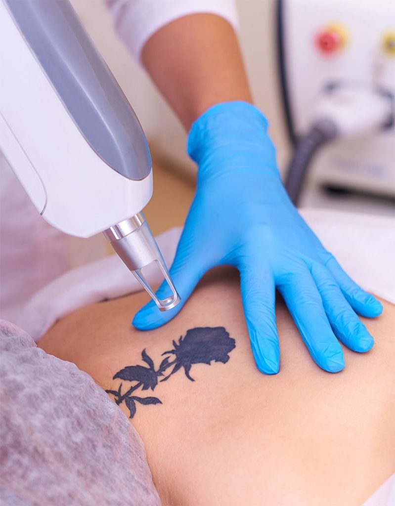 laser tattoo removal in jaipur