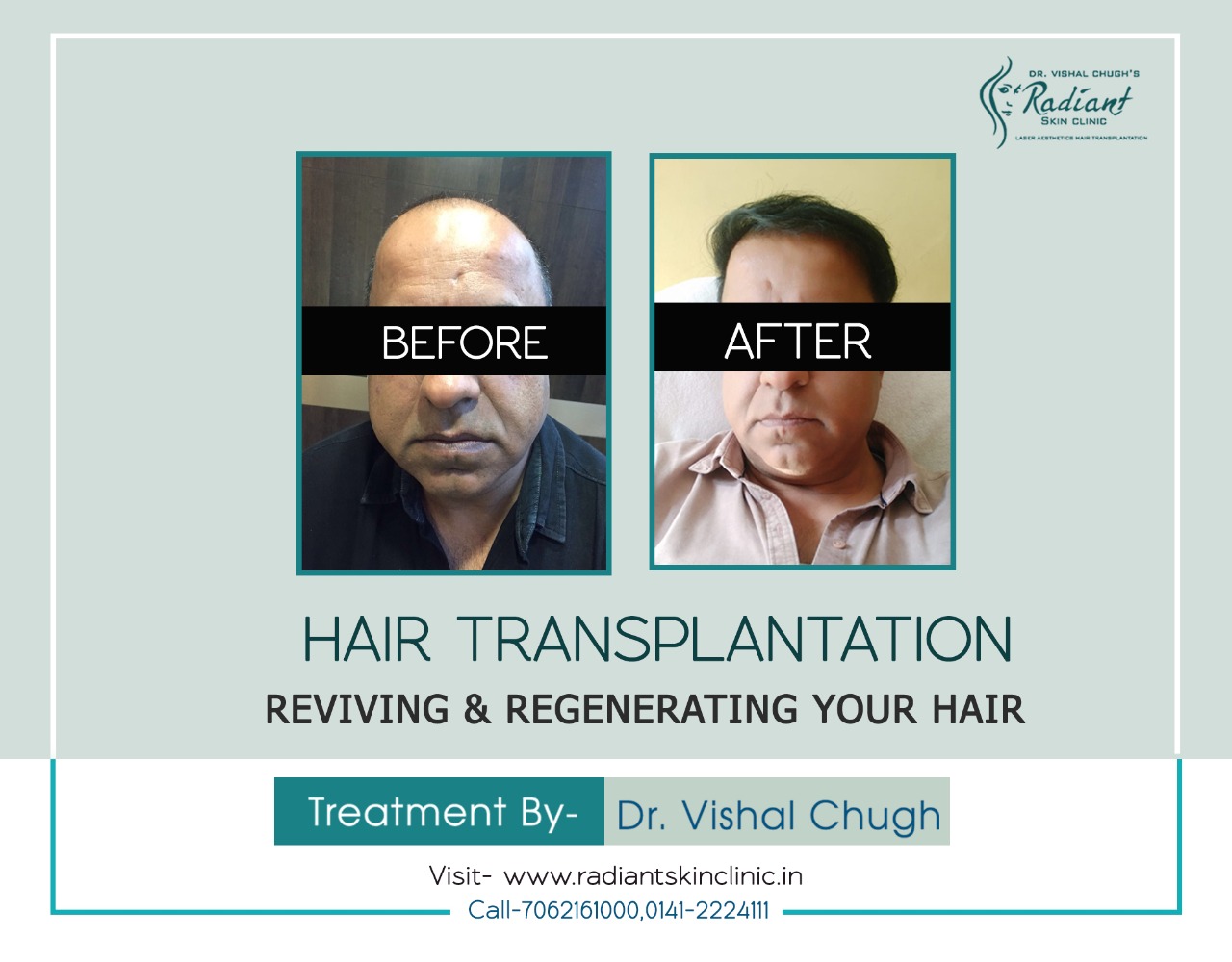Revive and Regenerate your hair with hair transplantation  