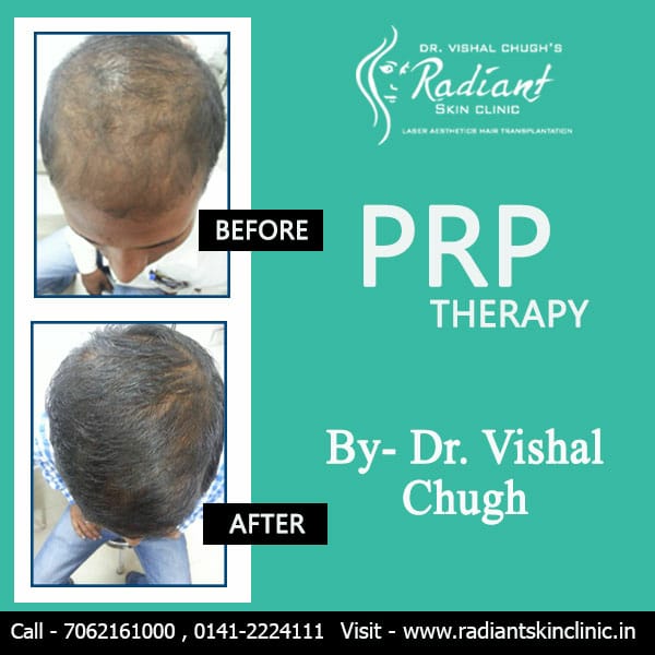 PRP therapy