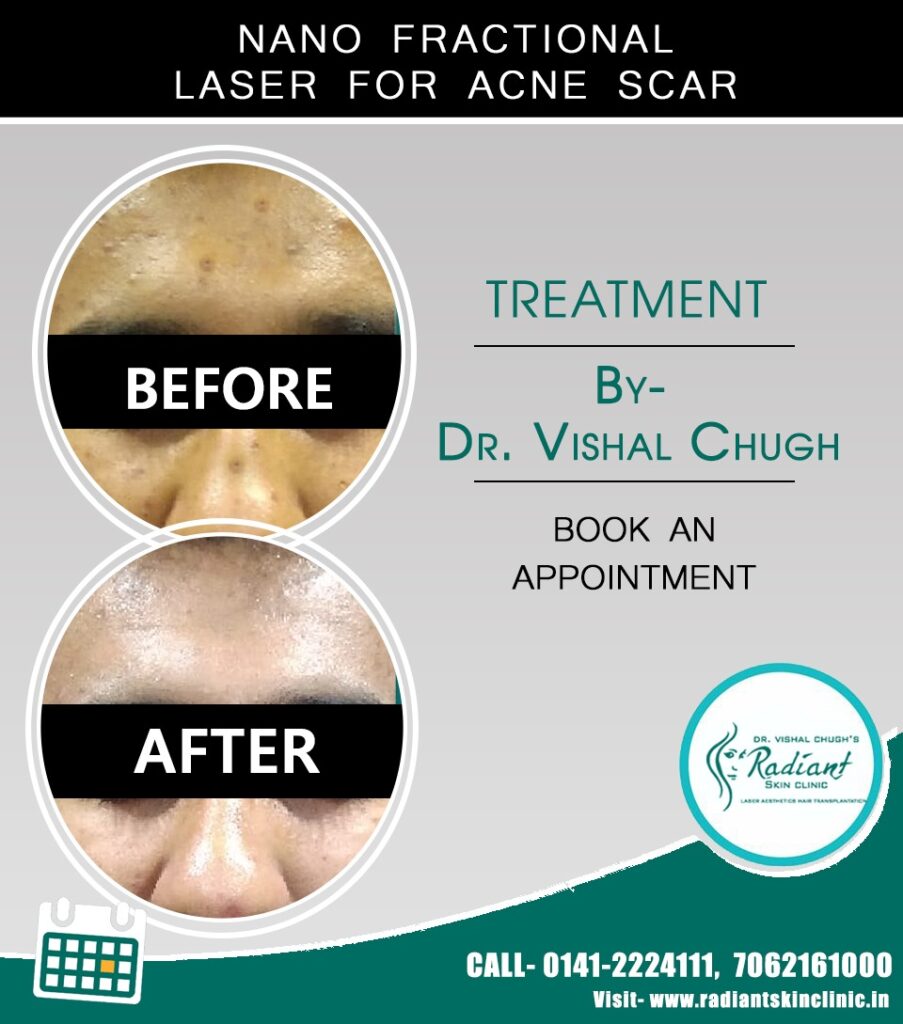 acne treatment in jaipur