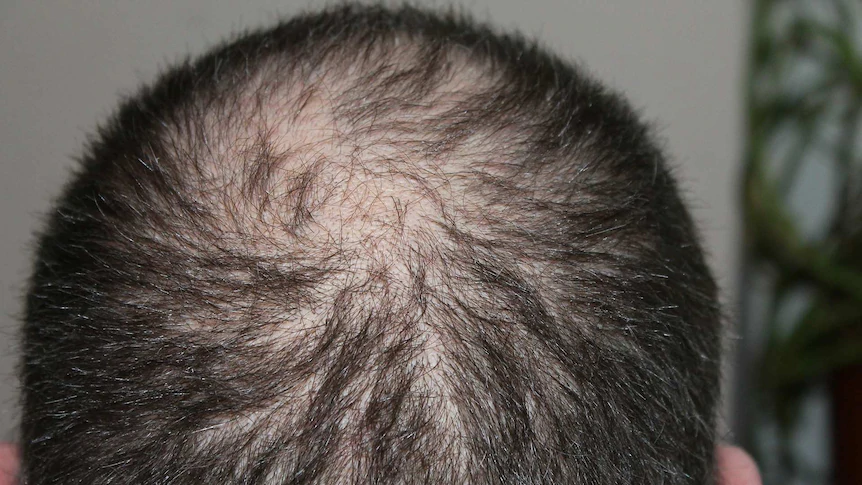 best hair transplant treatment in jaipur