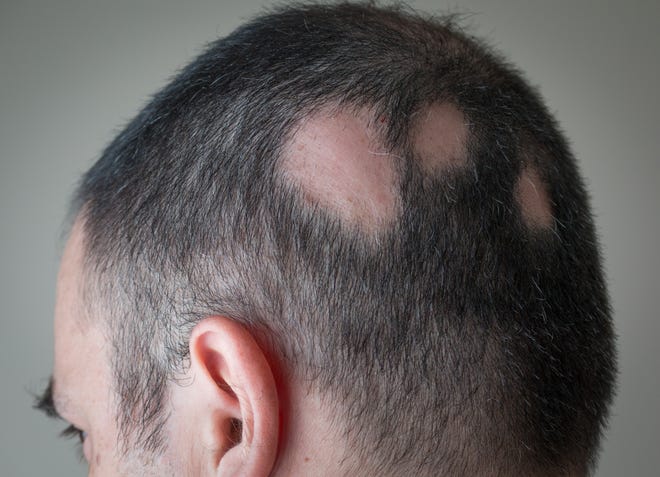 best hair transplant treatment in jaipur