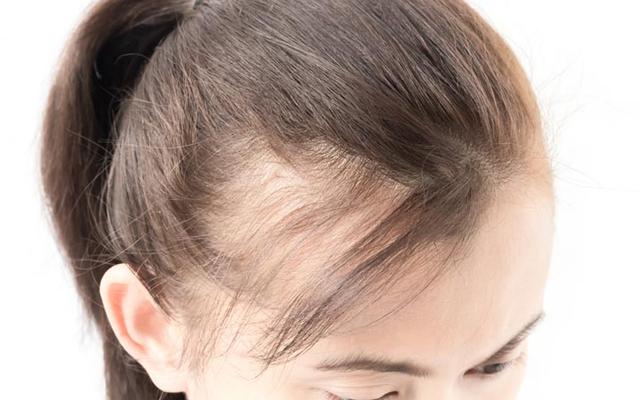 best hair transplant treatment in jaipur