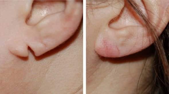 earlobe repair treatment in jaipur