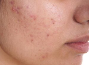 acne skin treatment in Jaipur