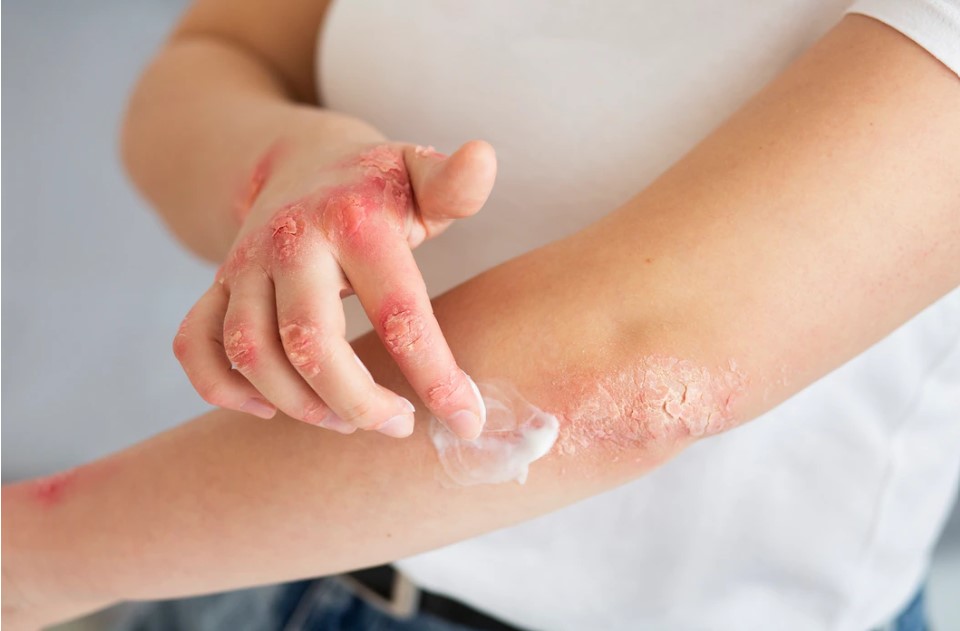 eczema treatment