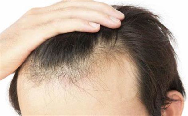 Symptoms of Alopecia