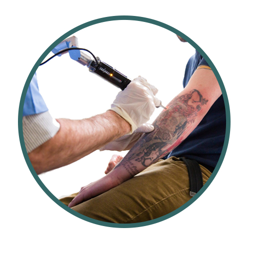 Tattoo Removal In Jaipur