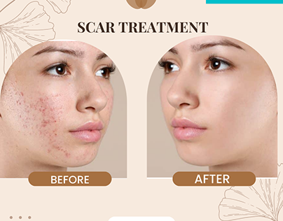 Acne Scar removal for sensitive skin