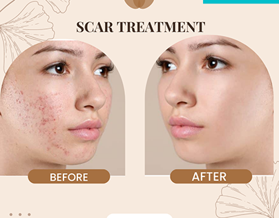 Best Laser Acne Scar Treatment in Jaipur