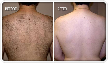Laser Hair Removal Archives - Radiant Skin Clinic- Laser Hair Removal &  Dermatologist in Jaipur