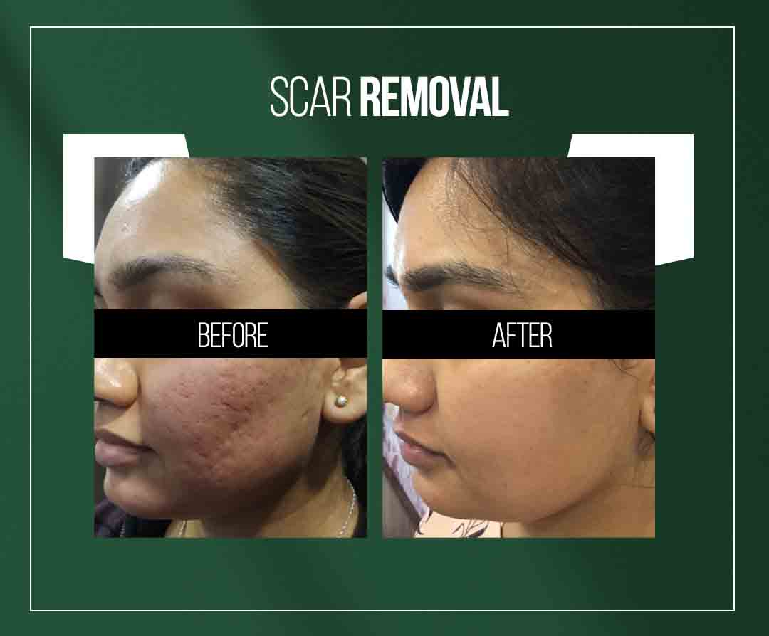 acne scar removal treatment in jaipur by dr vishal chugh