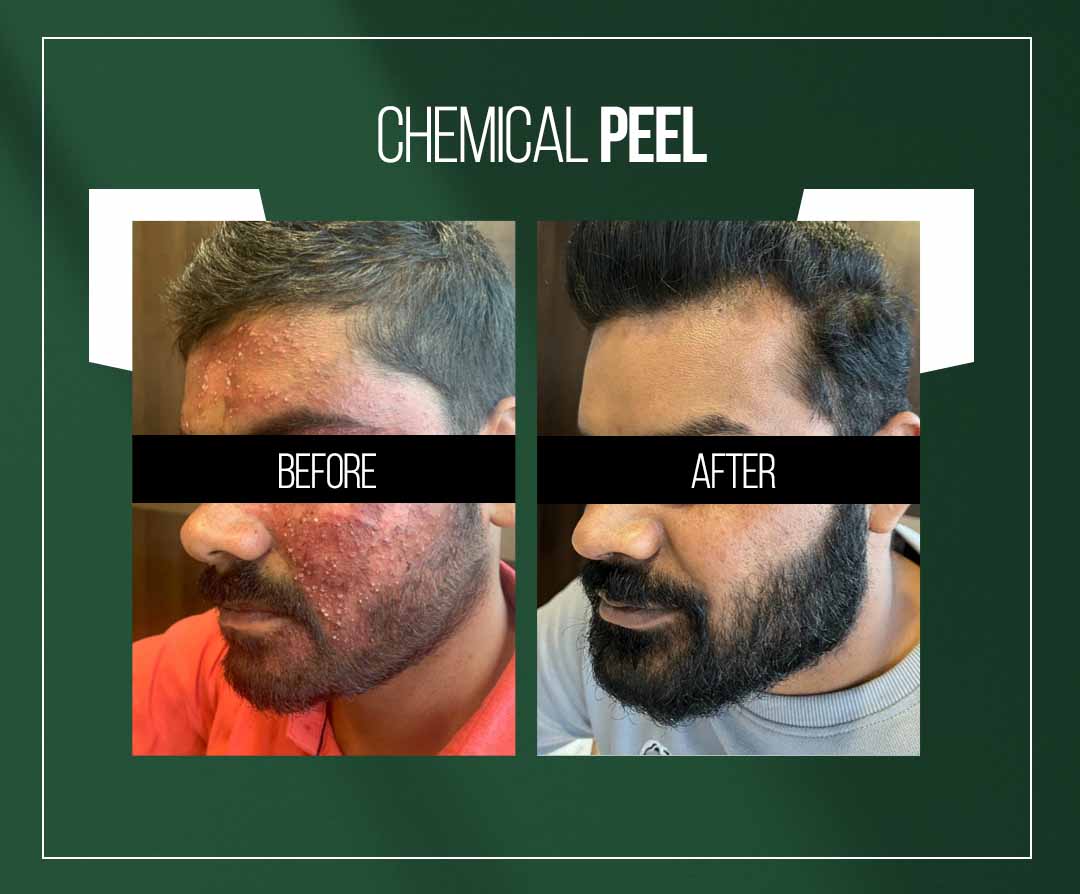 chemical peel treatment for acne scar treatment in jaipur