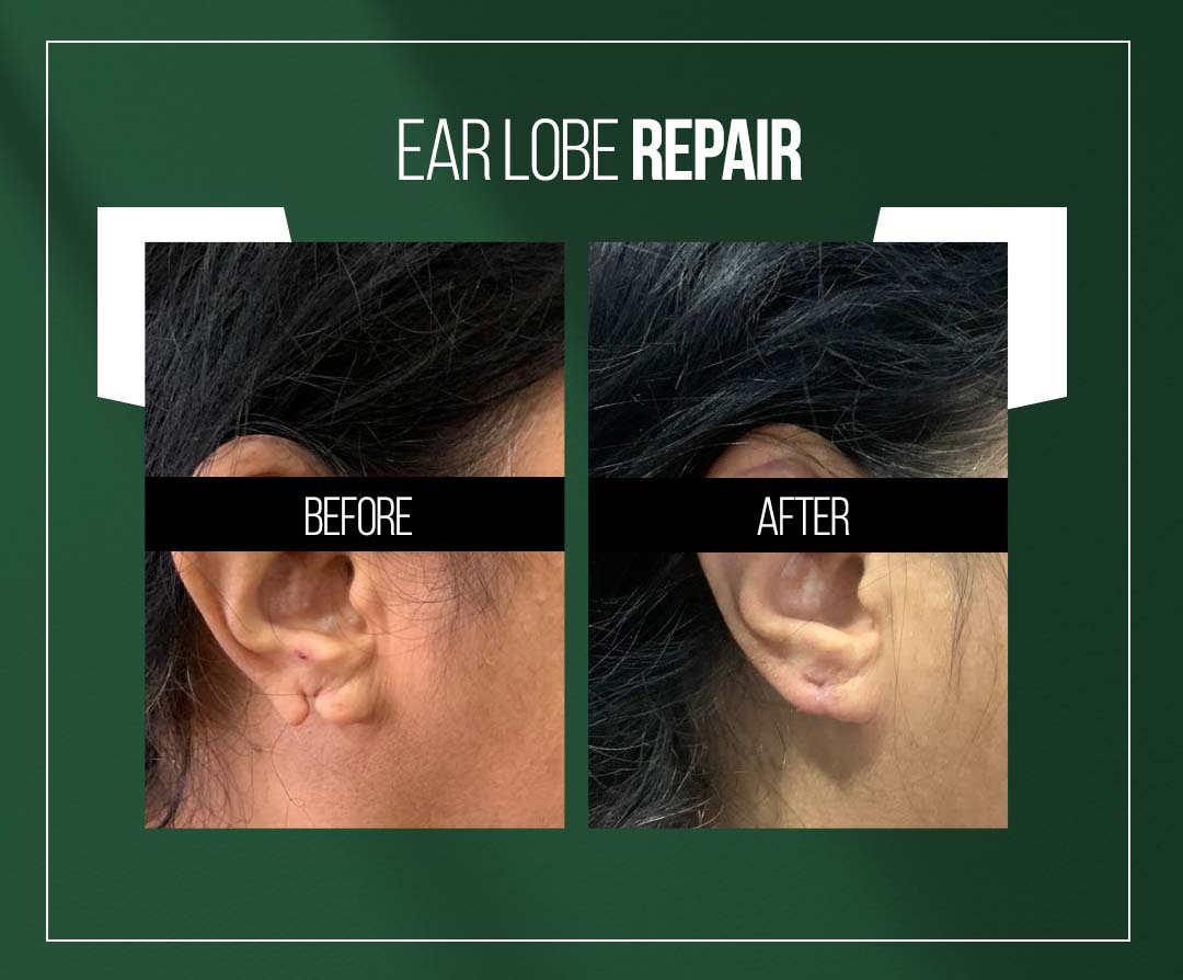 earlobe repair treatment in jaipur by dr vishal chugh