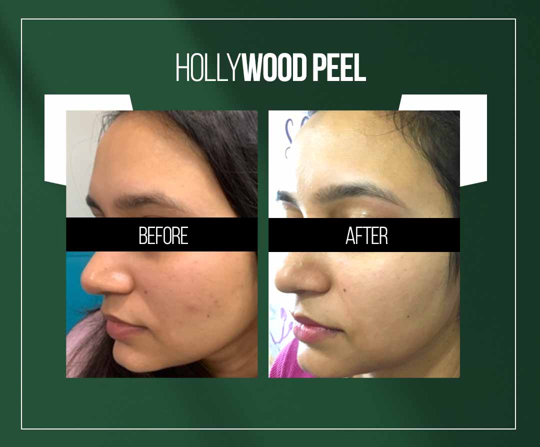 hollywood peel treatment in jaipur