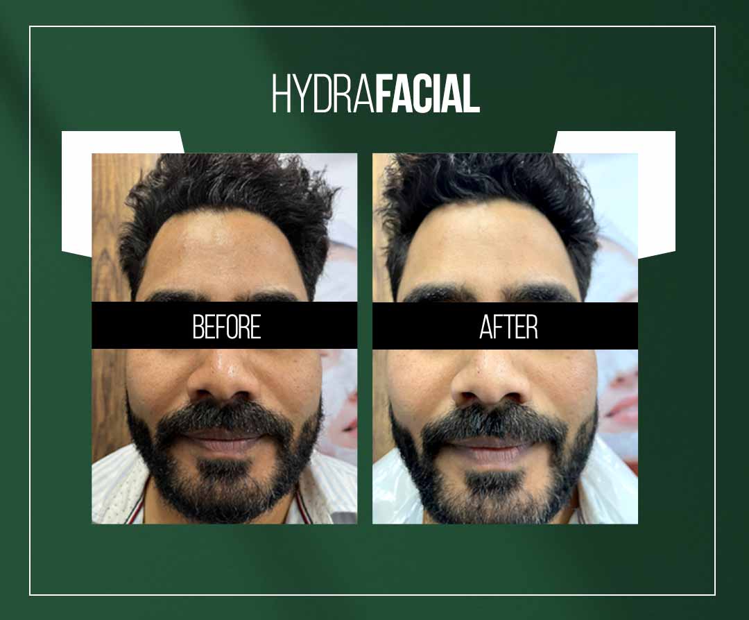 hydrafacial treatment in jaipur