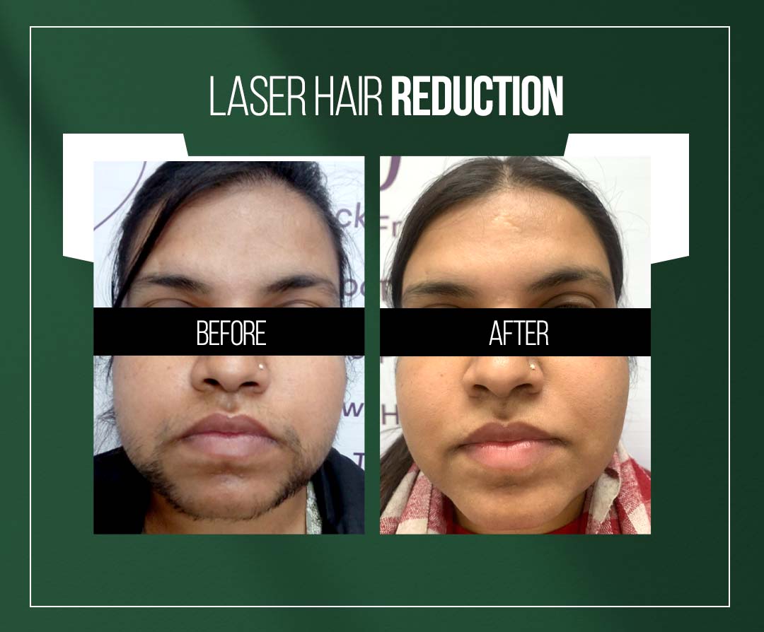 laser hair reduction treatment in jaipur by dr vishal chugh
