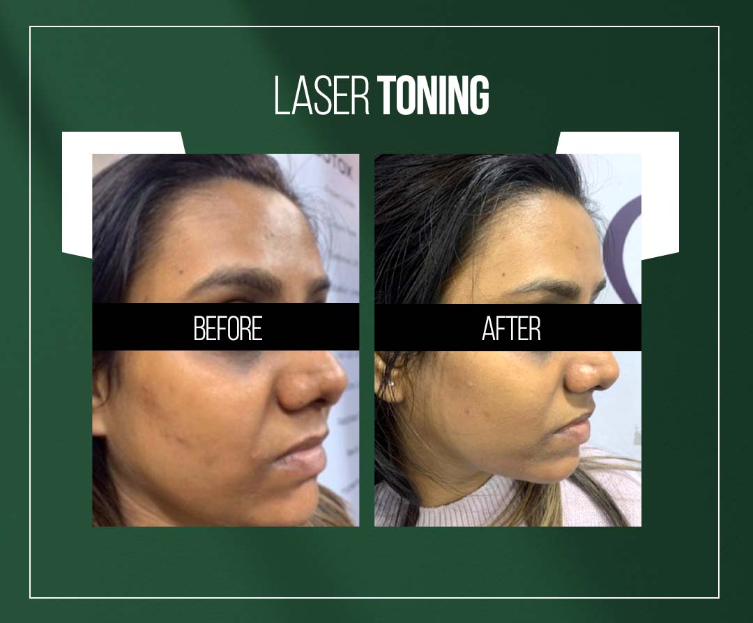 laser toning treatment skin whitening treatment in jaipur