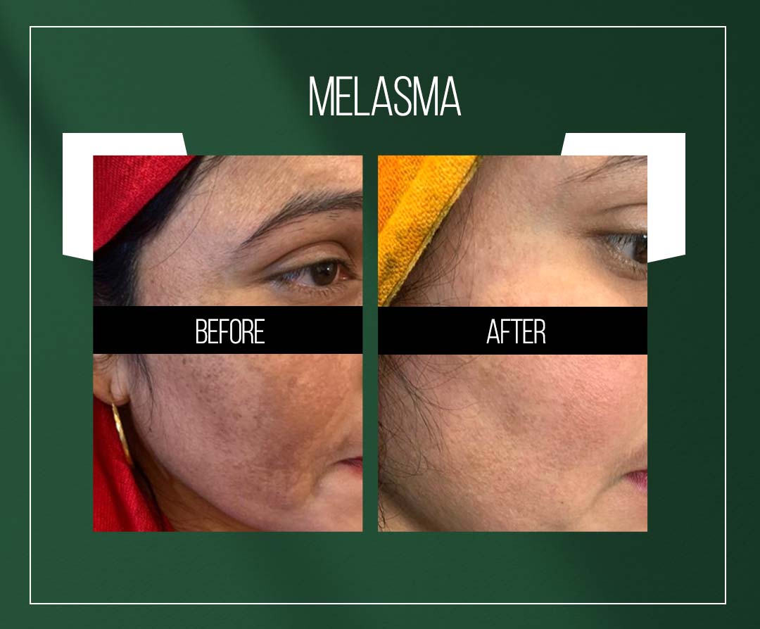 melasma chemical peel treatment in jaipur