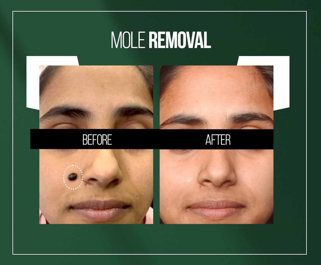 mole removal treatment in jaipur by dr vishal chugh