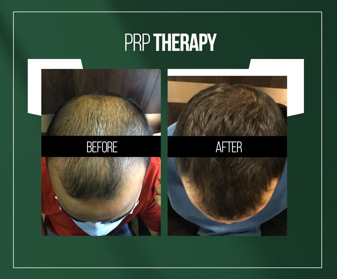 prp-therapy-treatment-for-hair-loss-in-jaipur-by-dr-vishal-chugh