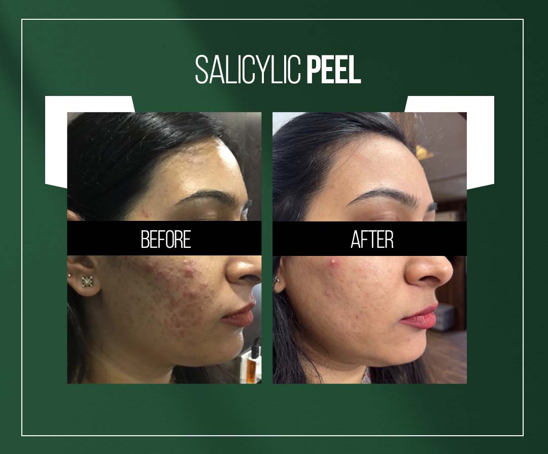 salicylic peel treatment in jaipur for acne scars