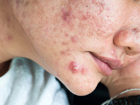 acne scar treatment in jaipur