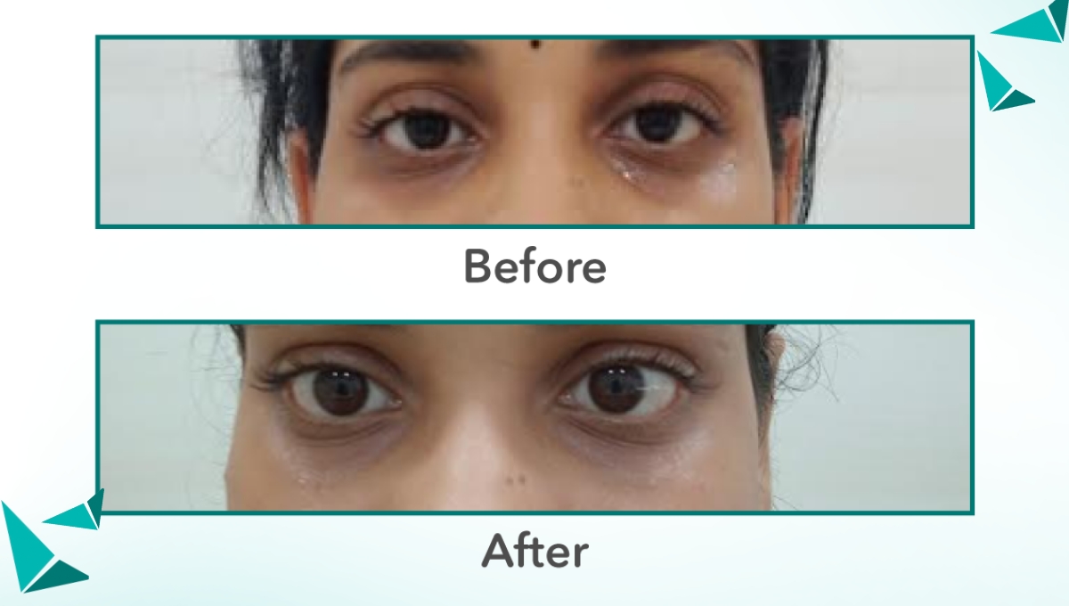 Skin Dermal Fillers in Jaipur