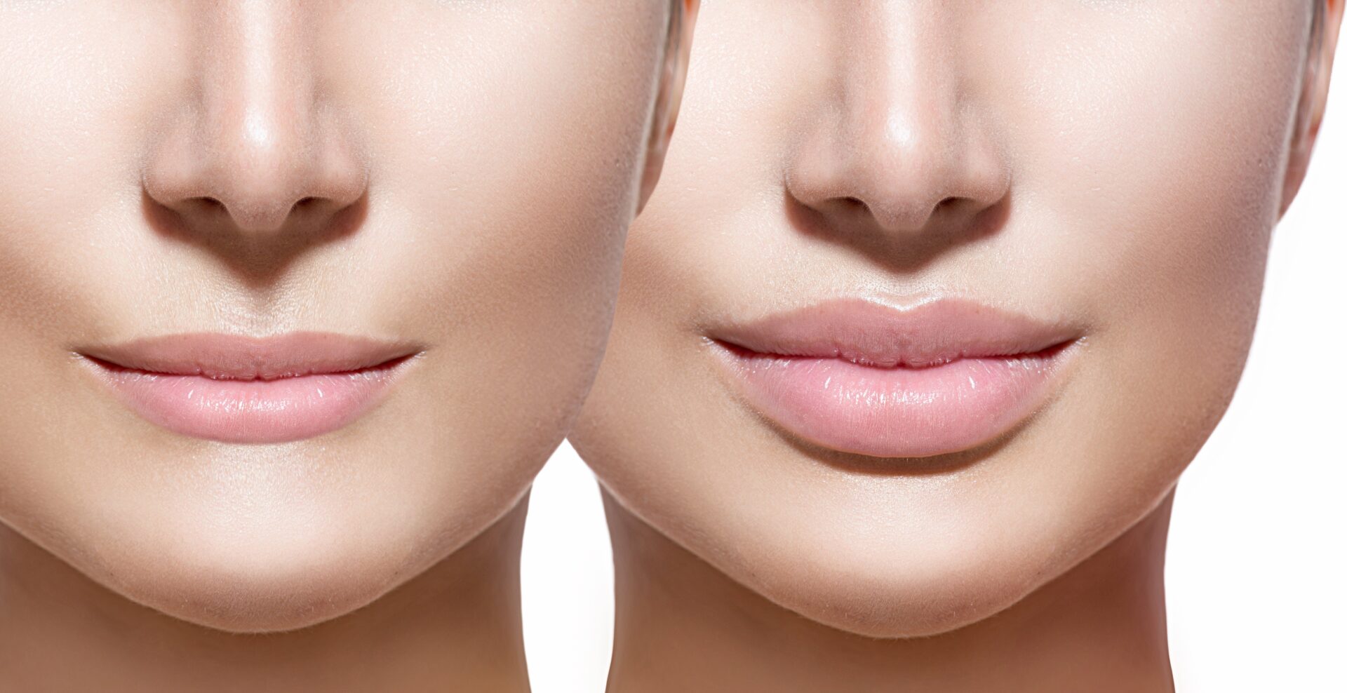 Before-and-After-Lip-Fillers