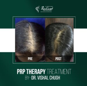 Best PRP Therapy Treatment in Jaipur