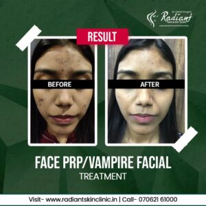 Best Facial PRP Therapy Treatment in Jaipur