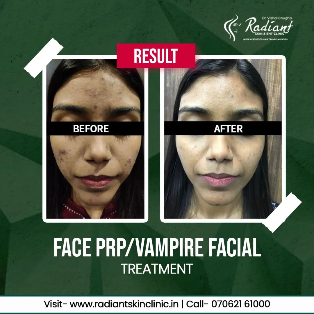 PRP Treatment in Jaipur