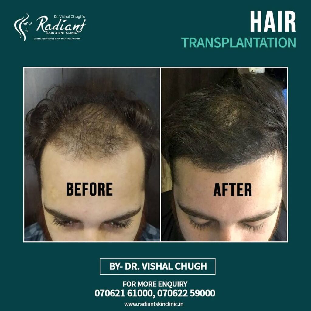Best Hair Transplant Clinic in Jaipur, Hair Transplant Treatment in Jaipur, Best Hair Transplant Doctor in Jaipur,Best Hair Transplant Treatment in Jaipur, Hair Transplant Cost in Jaipur, Hair Transplant Doctor in Jaipur