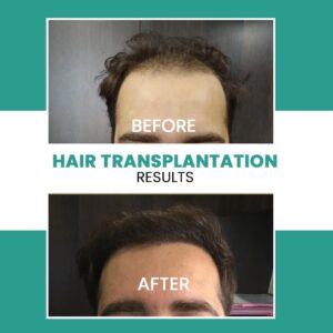 Best Hair Transplant Treatment in Jaipur