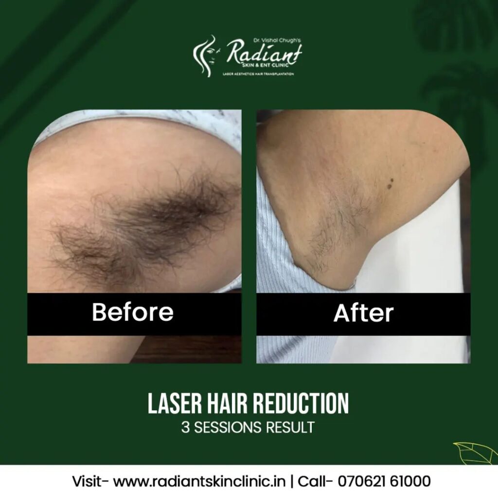 Laser Hair Removal Treatment in Jaipur